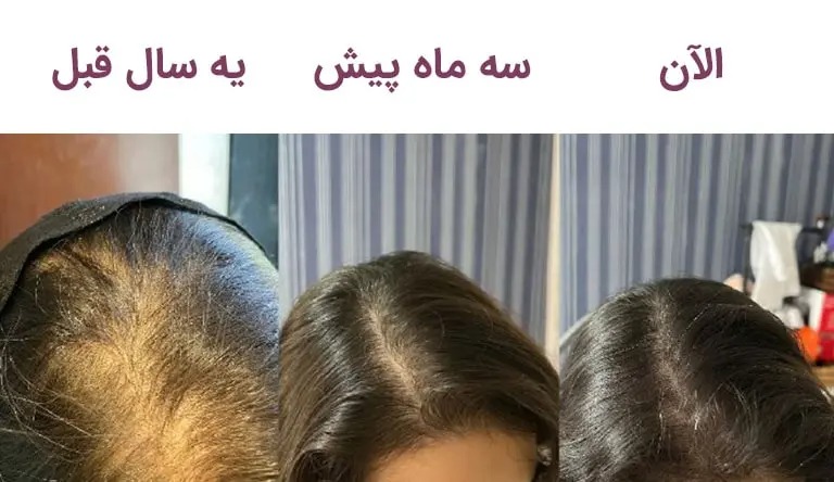 کارایی تونیک گیاهی هیرفرند